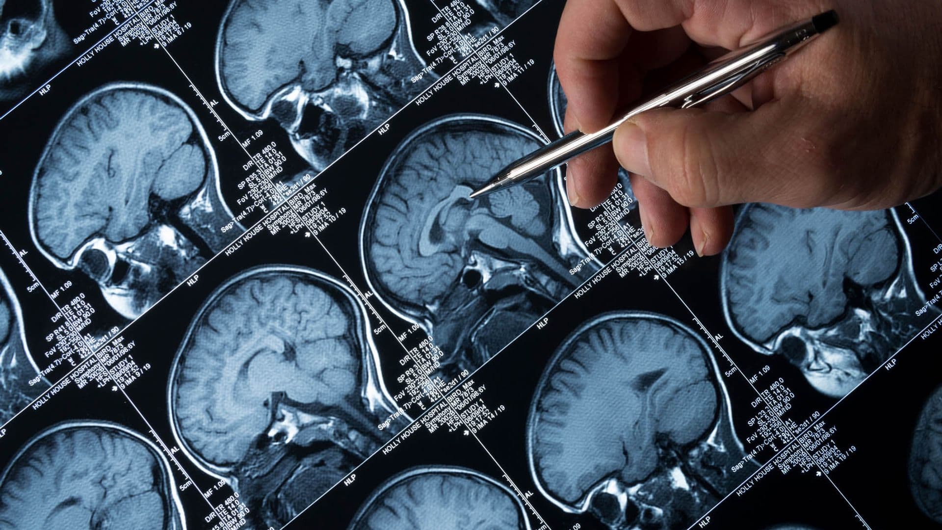 Pioneering Alzheimer
